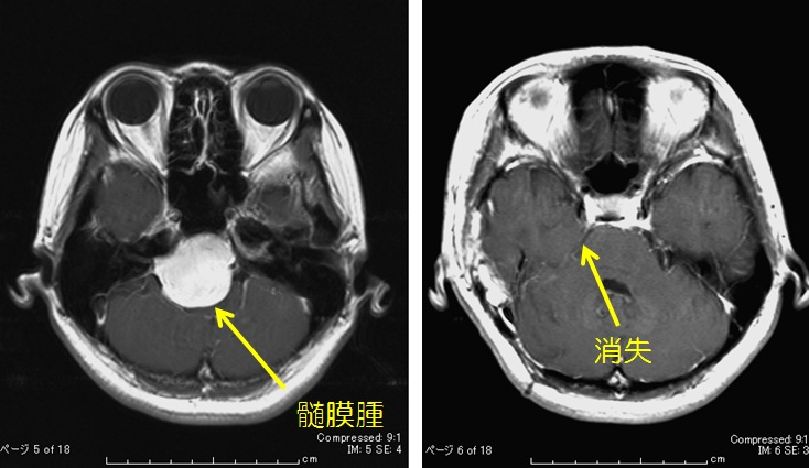 良性脳腫瘍 | 横浜市立大学医学部・医学研究科 脳神経外科学教室