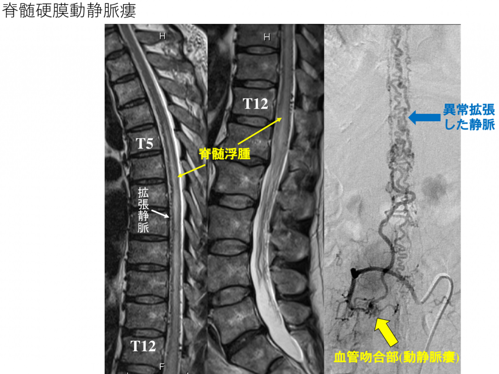 脳・脊髄動静脈奇形と頭蓋内・脊髄硬膜動静脈瘻　裁断済